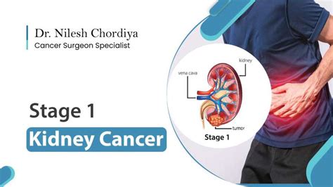 Stage 1 Kidney Cancer: Symptoms, Diagnosis & Treatment