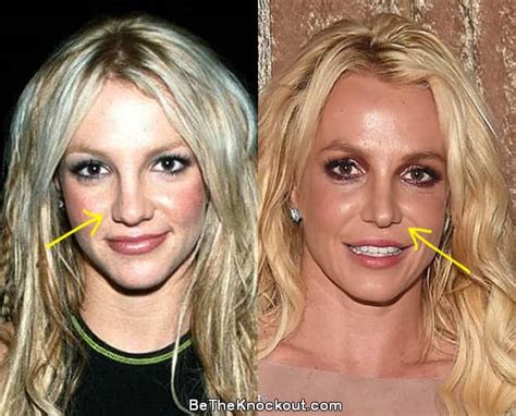 Britney Spears Plastic Surgery Comparison Photos