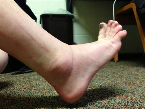 My Broken Ankle: Swollen ankle (10 Weeks Post-Op)