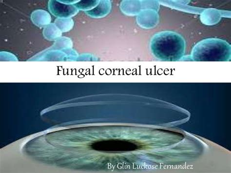 Fungal corneal ulcer 3rd yr