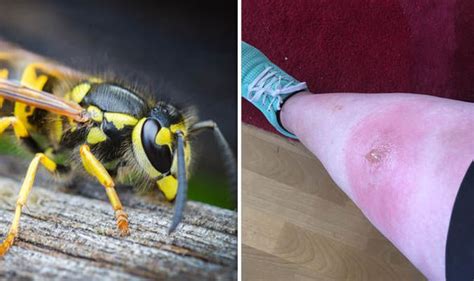 WASP INVASION: Shocking pictures show how sting became pus-filled lump ...