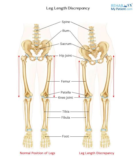 Leg Length Discrepancy