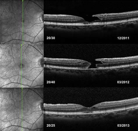 Spontaneous Conversion of Lamellar Macular Holes to Full-Thickness ...