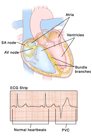 Premature Ventricular Contractions | Saint Luke's Health System