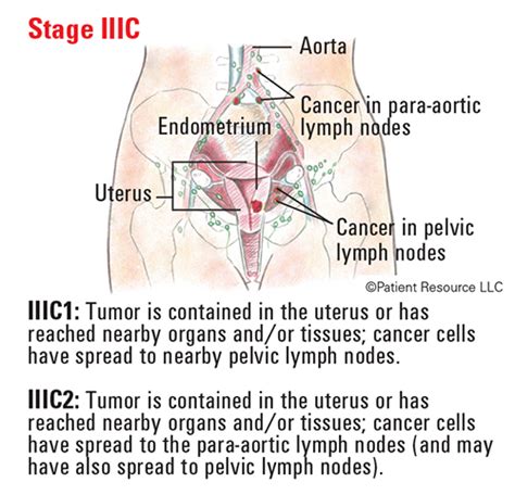 Uterine Cancer Staging