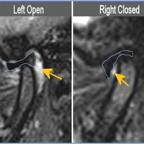 Central view MRIs of patient in Figure 4 above. Left condyle is more... | Download Scientific ...