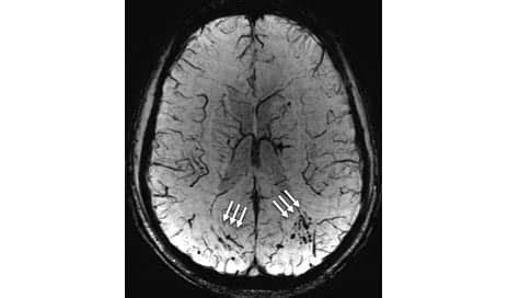 MRI Study Suggests Brain Damage in Military Personnel Who Experienced Blast-Related Mild TBI ...