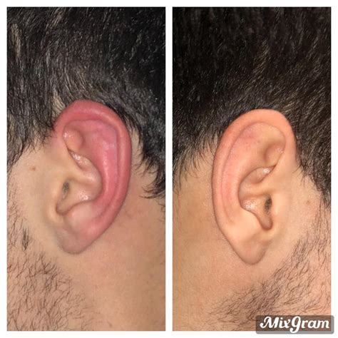 Cauliflower Ear Before And After