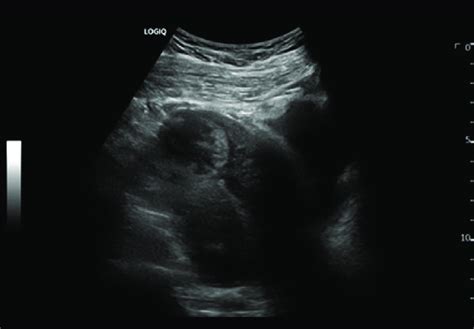 Ultrasound of pregnancy without intrauterine implantation. Ultrasound... | Download Scientific ...