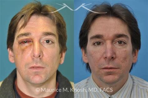 New York Facial Fracture Repair | Maurice M. Khosh MD, FACS