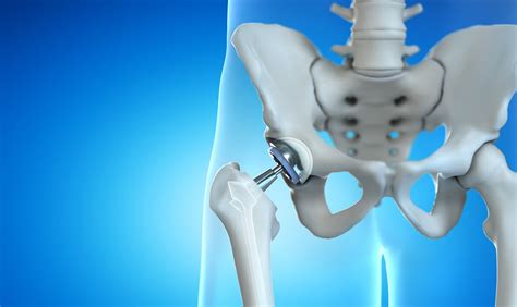 What Is Anterior Hip Replacement Surgery at Misty Hamrick blog