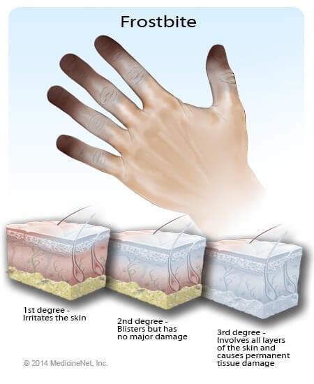 Medical Definition of Frostbite