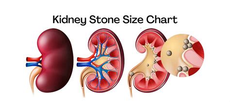 Kidney Stone Size Chart in MM and CM | Learn from doctor