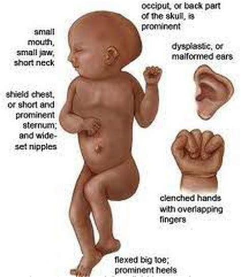 Symptoms of Edwards syndrome - MEDizzy