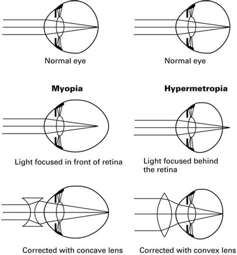 Difference between Hyperopia and Myopia