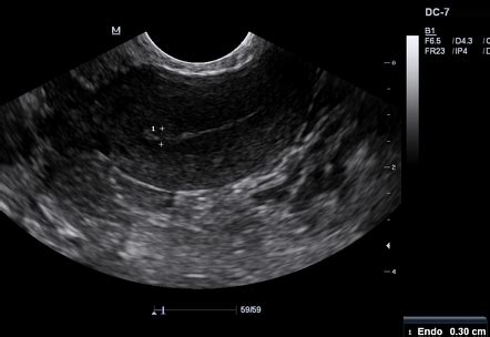 Endometrial thickness | Radiology Reference Article | Radiopaedia.org