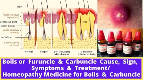 Boils or Furuncle & Carbuncle Cause, Sign, Symptoms & Treatment ...