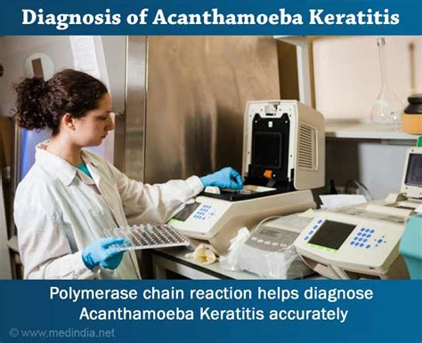 Acanthamoeba Keratitis - Symptoms, Signs, Diagnosis & Treatment