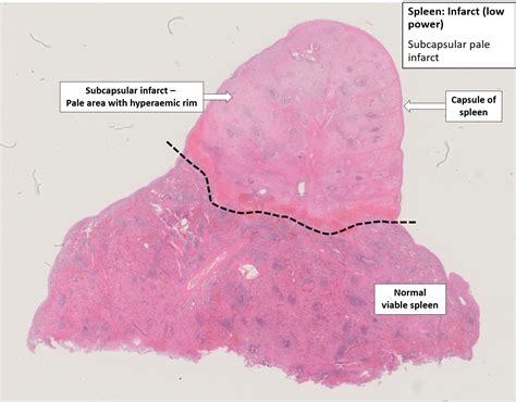 Spleen – Infarct – NUS Pathweb :: NUS Pathweb