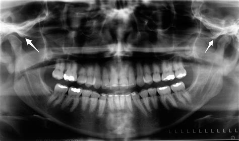 Anatomy Monday: Anterior Articular Eminence (Temporal Bone) – Dr. G's Toothpix