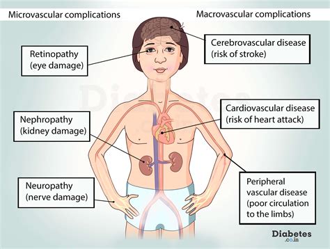 Diabetes Complications