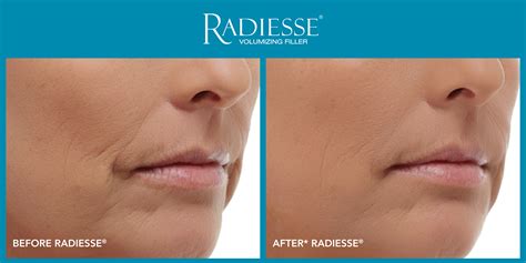 Fill in, Plump up, and Rejuvenate: Radiesse? Has the Answer!