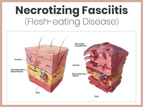 Necrotizing Fasciitis: Causes, Symptoms, Diagnosis, Treatment, And ...