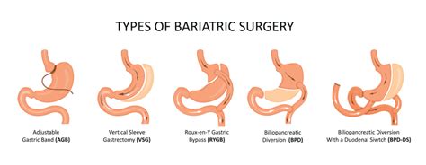 Bariatric Surgery | Lifestyle Medical Centers