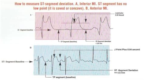 how to measure st segment elevation | Dr.S.Venkatesan MD