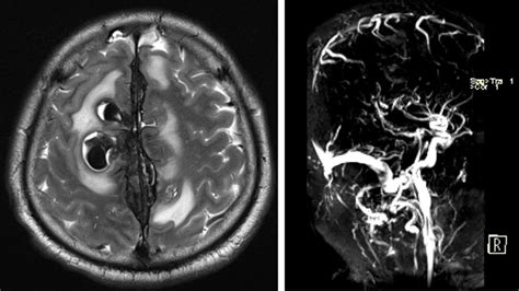 Superior sagittal sinus thrombosis with intraparenchymal haemorrhages ...