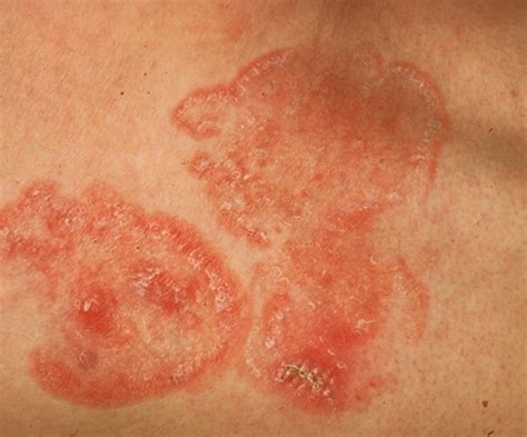 Mycosis Fungoides - Pictures, Staging, Symptoms, Treatment and Causes | hubpages