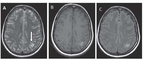 Cortical Laminar Necrosis as a Presenting Manifestation of Migraine in an Apparently Normal ...