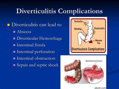 PPT - Diverticulosis & Diverticulitis PowerPoint Presentation, free download - ID:6817083