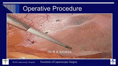 Dr R K Mishra's Lecture on Laparoscopic Repair of Ventral Hernia - YouTube