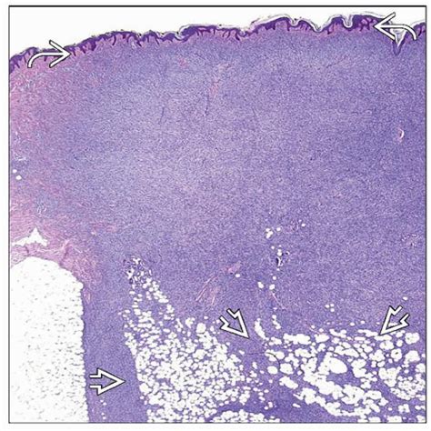 Dermatofibrosarcoma Protuberans | Basicmedical Key