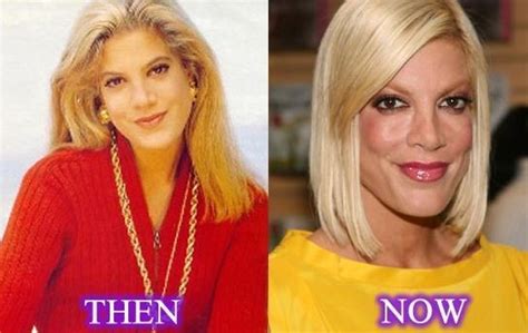 Tori Spelling before and after plastic surgery 09 – Celebrity plastic ...