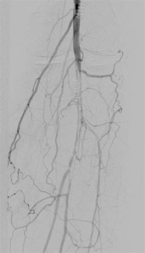 Aortogram with runoff demonstrating occlusions in the left distal... | Download Scientific Diagram