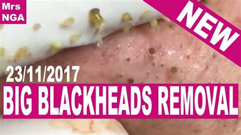 Big Blackheads Removal - YouTube