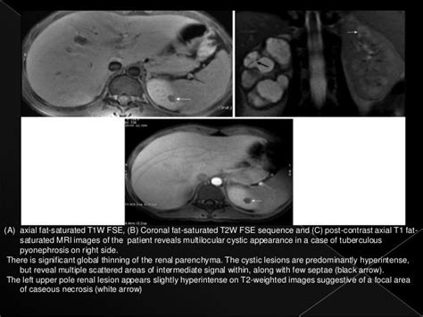 Renal tuberculosis radiology