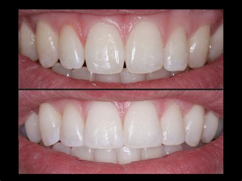 Dental Tips - Smile Dentistry: All You Need To Know About Tooth Bonding