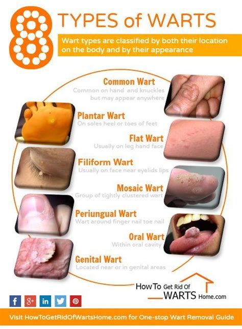 Pin on Types Of Warts