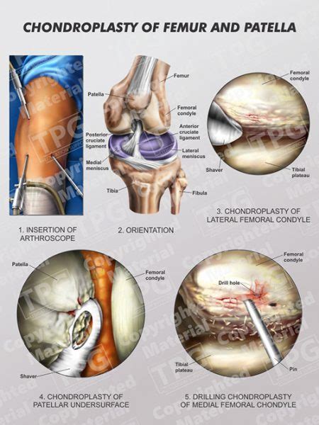 Chondroplasty of Femur and Patella - Order