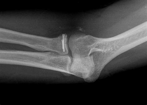 Elbow Fractures