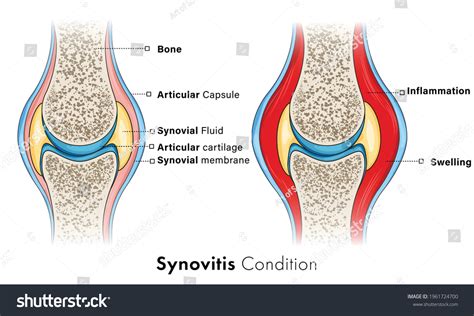 Sinovitis de las articulaciones óseas en: vector de stock (libre de regalías) 1961724700 ...