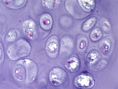 Osteochondroma pathophysiology - wikidoc