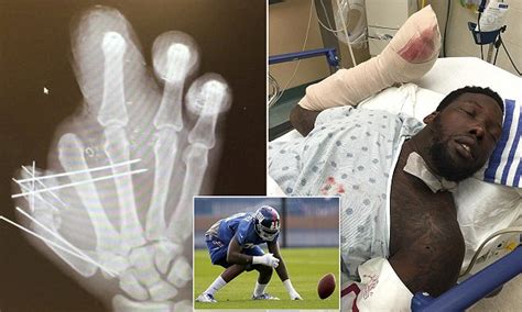 New York Giants star Jason Pierre-Paul releases X-ray of his mangled ...