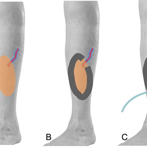 (A) The defect was managed with fasciocutaneous flap coverage, and... | Download Scientific Diagram