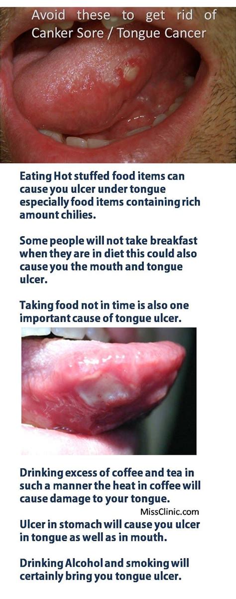 Avoid Periodical Tongue Ulcer Remedies ~ Missclinic | Tongue ulcer ...