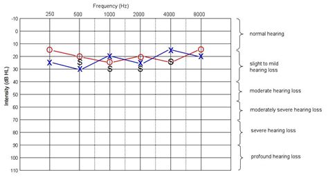 How to Read an Audiogram