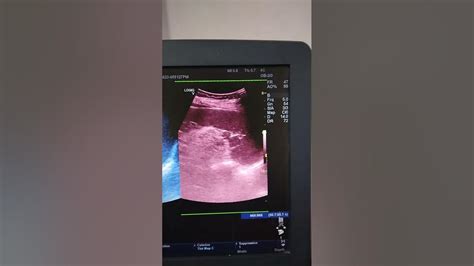 Accessory spleen. Ultrasound - YouTube